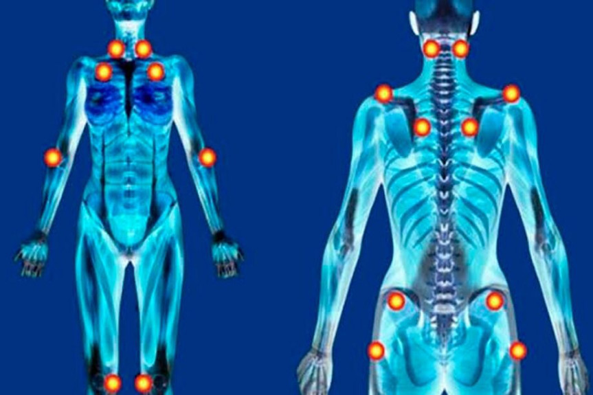 A fibromialgia, reconhecida no Catálogo Internacional de Doenças desde 2004, sob o código CID-10 M79.7, é uma doença crônica e multifatorial que causa dores generalizadas.