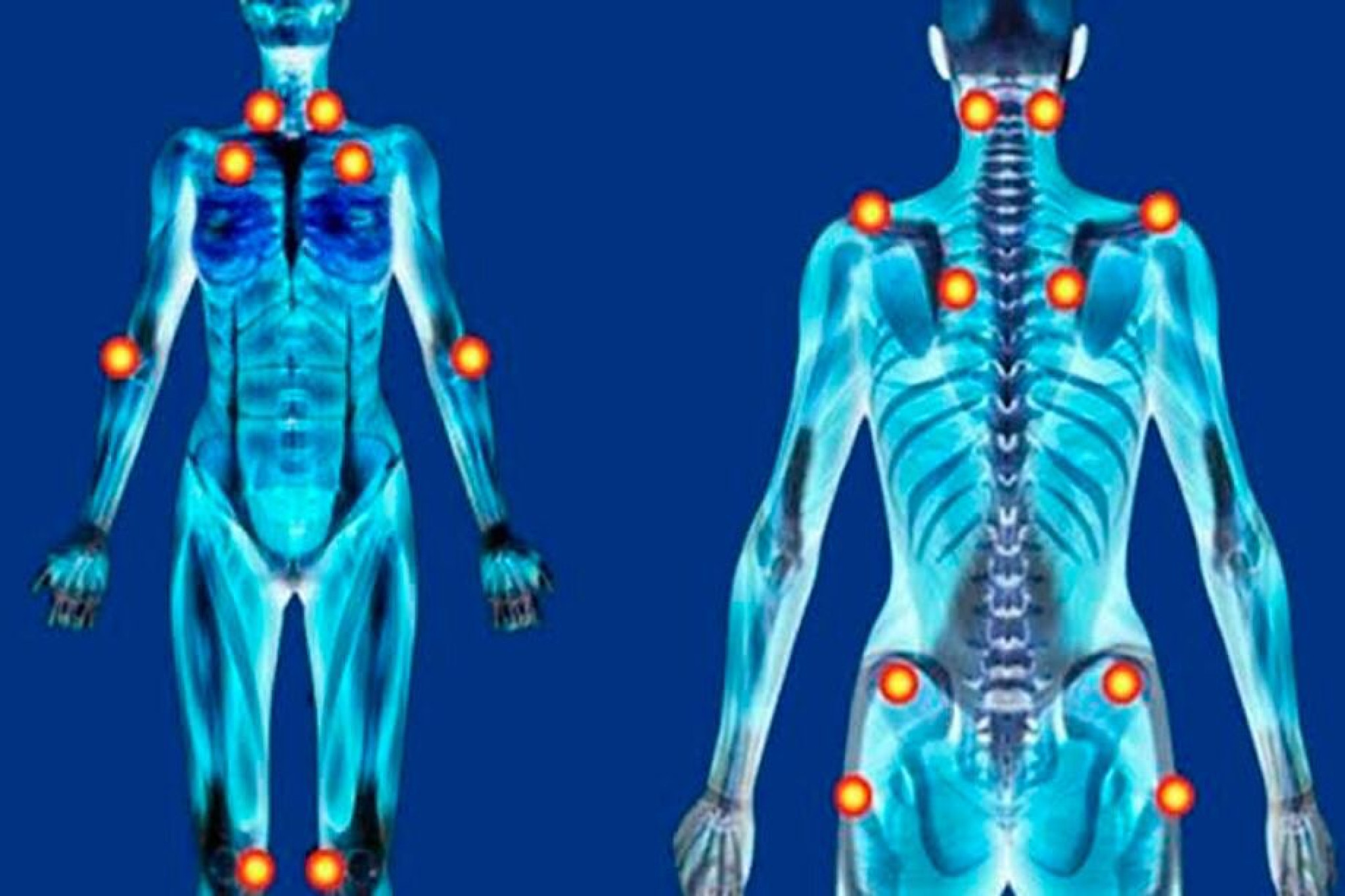 Projeto prevê tratamento da fibromialgia como política pública no Paraná